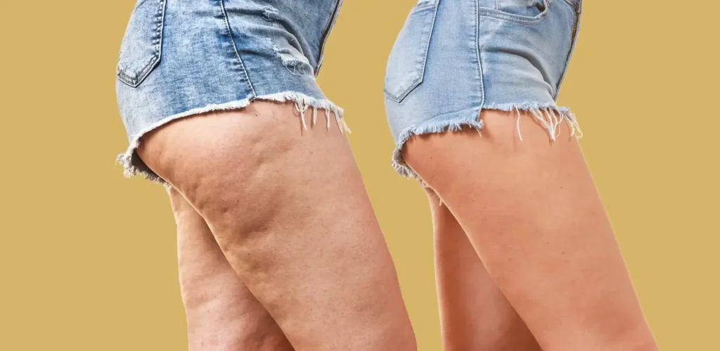 Cellulite Myths: What’s True and What’s Not?